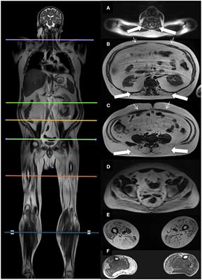 Patients With Becker Muscular Dystrophy Have Severe Paraspinal Muscle Involvement